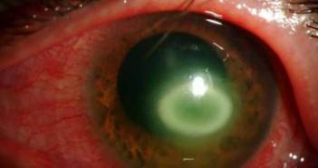 Τι είναι η ακανθαμοιβαδική κερατίτιδα;