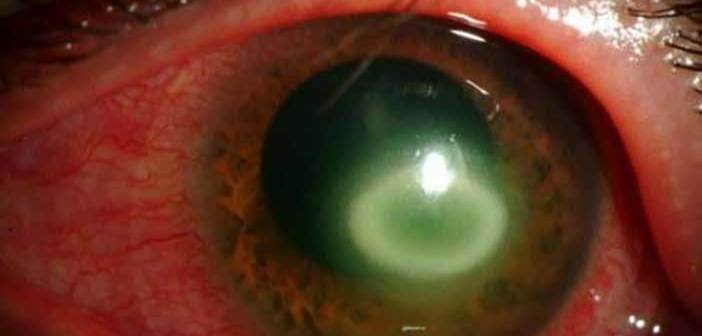 Τι είναι η ακανθαμοιβαδική κερατίτιδα;