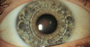 Τι είναι ακριβώς η δυσανεξία στους φακούς επαφής;