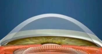 Ορθοκερατολογία και CRT