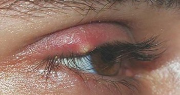 Έχεις βγάλει “κριθαράκι” στο μάτι; Να πως να το αντιμετωπίσεις