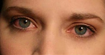 Κόκκινα μάτια: Σε τι μπορεί να οφείλεται το σύμπτωμα