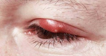 «Κριθαράκι» στο μάτι – Τι το προκαλεί και πως αντιμετωπίζεται