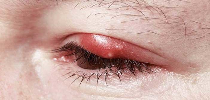 «Κριθαράκι» στο μάτι – Τι το προκαλεί και πως αντιμετωπίζεται