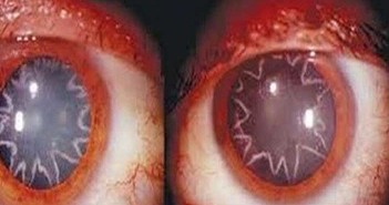 Έπαθε ηλεκτροπληξία και δείτε πως έγιναν τα μάτια του