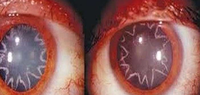 Έπαθε ηλεκτροπληξία και δείτε πως έγιναν τα μάτια του