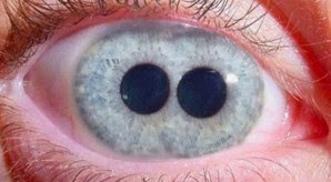 Άνθρωπος με δυο κόρες στους οφθαλμούς του