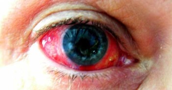 Αίμα στο μάτι - Πότε πρέπει να ανησυχήσετε