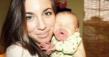 Το κοριτσάκι που γεννήθηκε με ανοφθαλμία