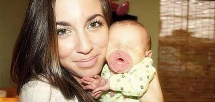 Το κοριτσάκι που γεννήθηκε με ανοφθαλμία