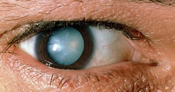 Μάθετε πώς να προστατεύσετε την όραση σας από τον καταρράκτη