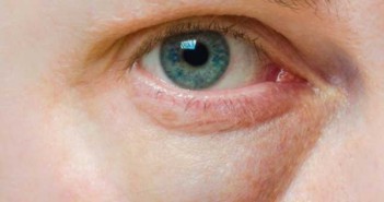 Γιατί οι ηλικιωμένοι έχουν σακούλες κάτω από τους οφθαλμούς τους;