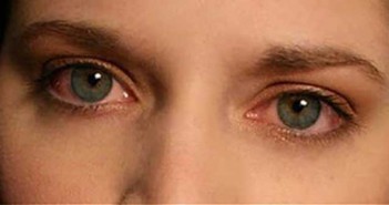 Γιατί τα μάτια μου είναι κόκκινα;