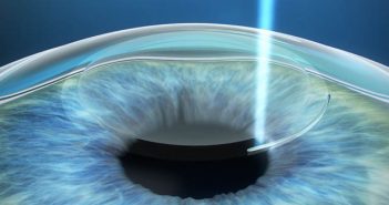 Διαθλαστική χειρουργική στα παιδιά