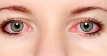 Ατοπική κερατοεπιπεφυκίτιδα