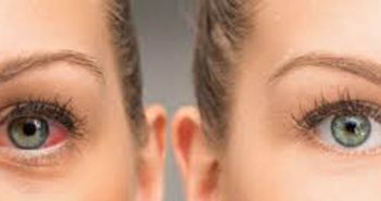 Αλλεργική επιπεφυκίτιδα