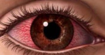 Οξεία αλλεργική επιπεφυκίτιδα