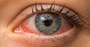 Χρόνια αλλεργική επιπεφυκίτιδα