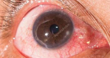 Λοιμώδης ενδοφθαλμίτιδα