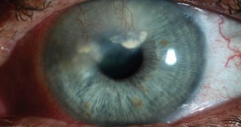 Ερπητική κερατίτιδα